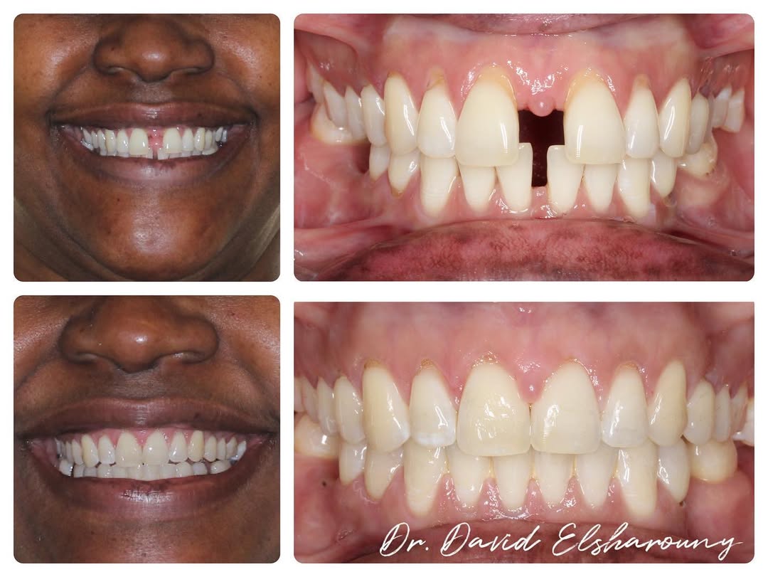 Before and after orthodontic smile result