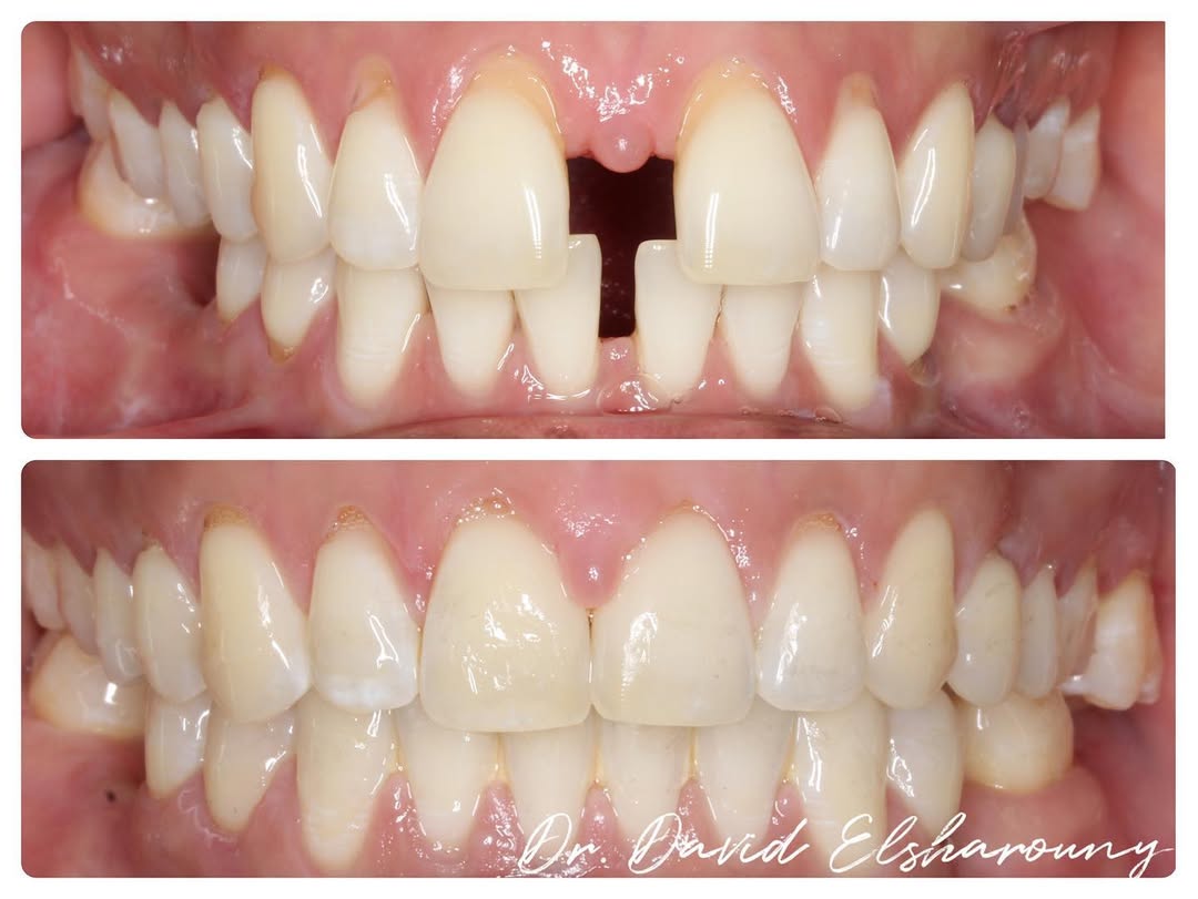 Before and after orthodontic case showing space closure