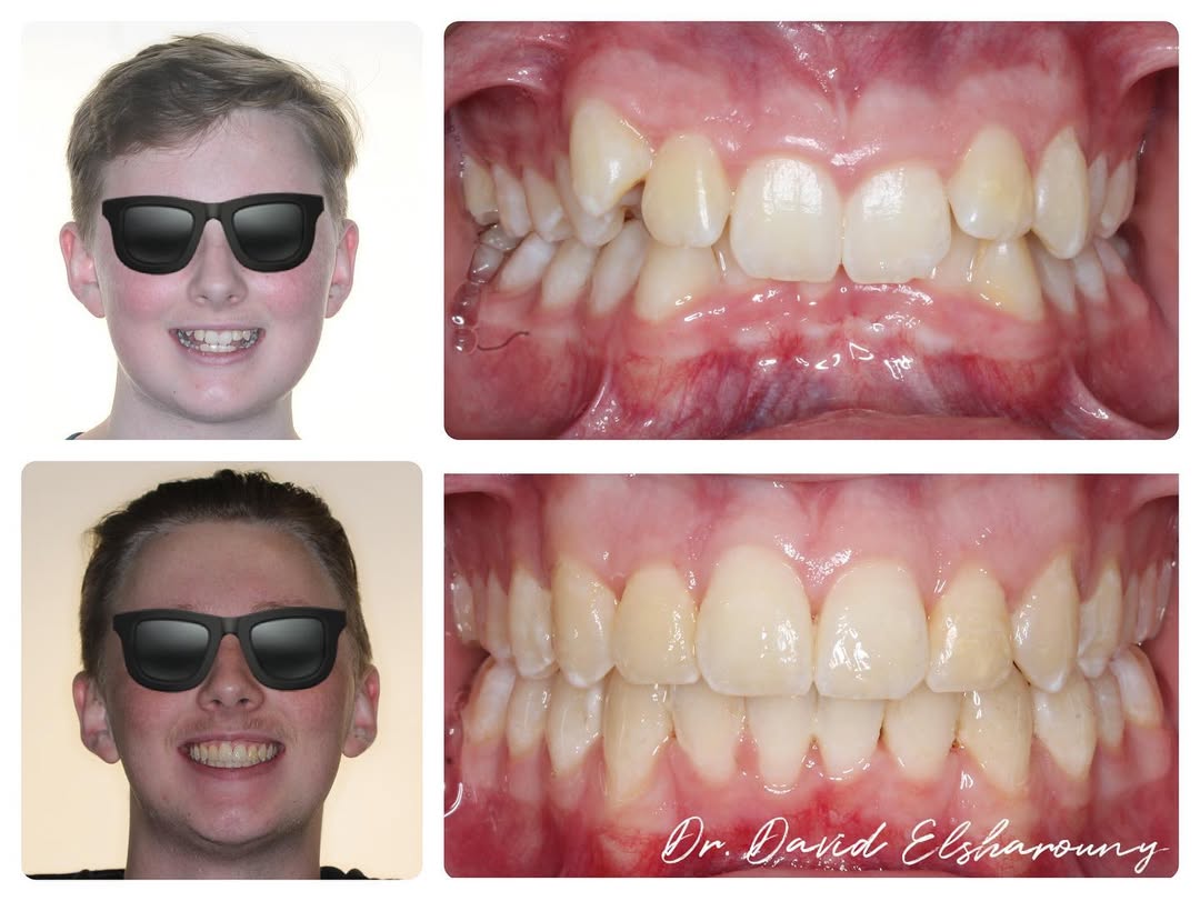 Before and after orthodontic results