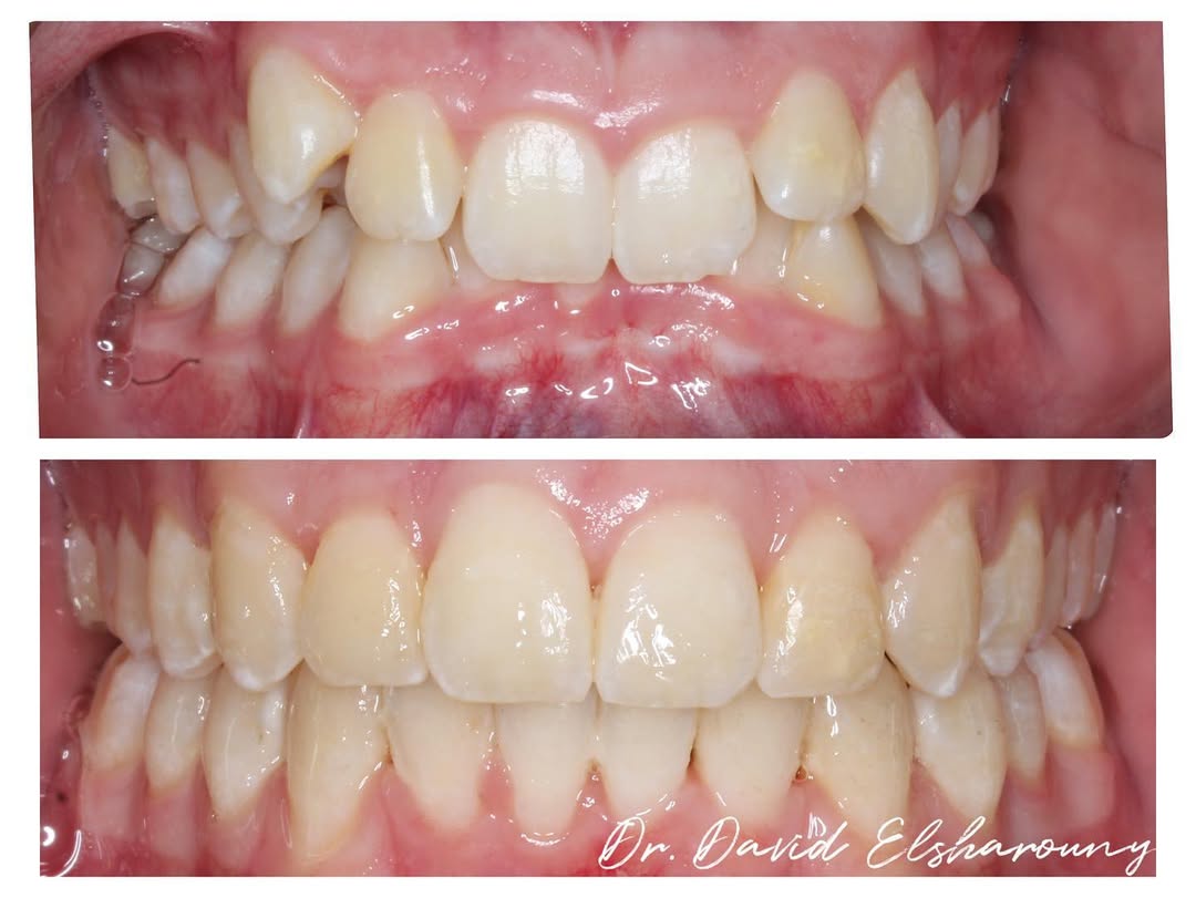 Before and after orthodontic alignment case