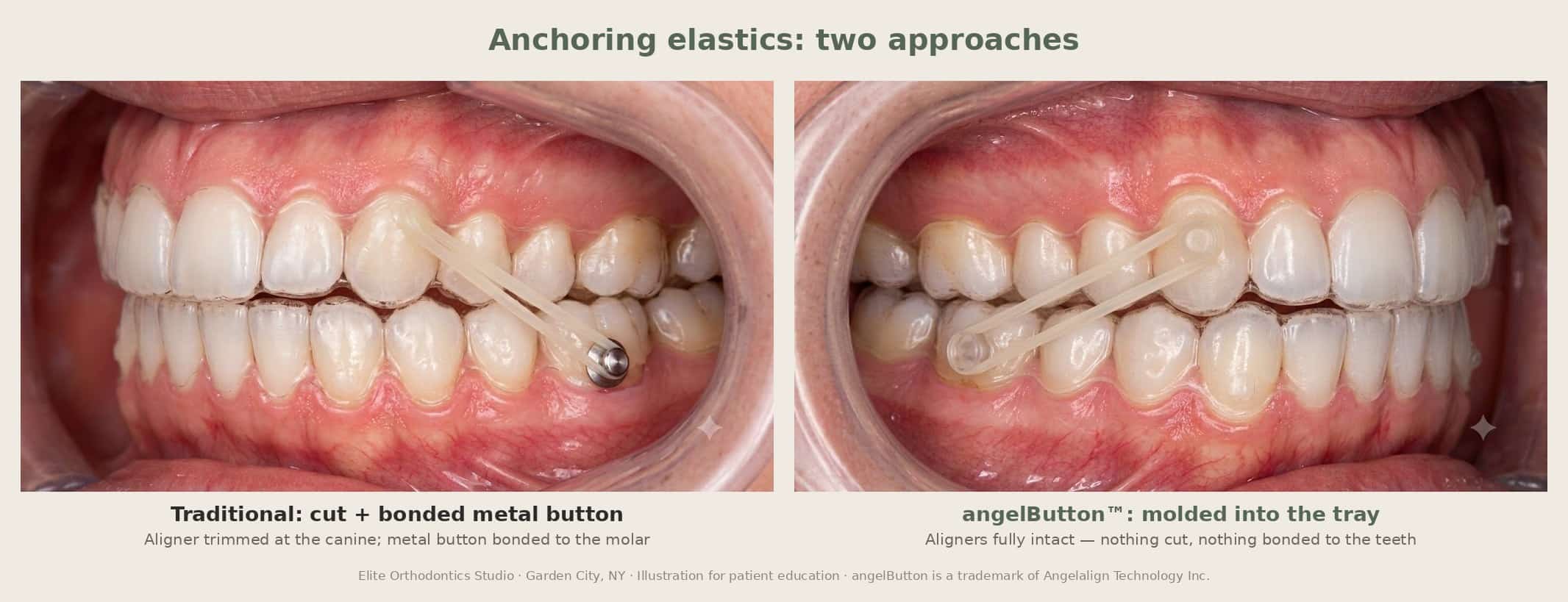 Illustration comparing elastic anchorage on clear aligners: a cut aligner with a bonded metal button versus the angelButton molded into the tray — Elite Orthodontics Studio, Garden City, NY